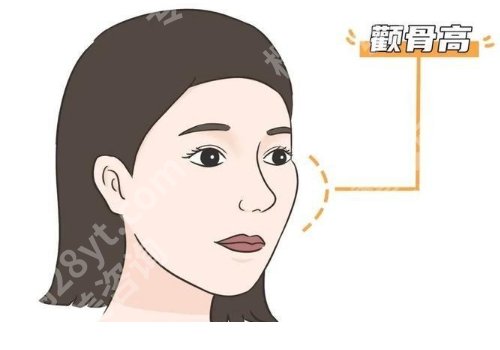 张笑天颧骨内推什么价格？附医生信息及术后tips