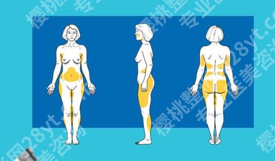 宋延刚吸脂多少钱？医生技术点评来袭！附案例图