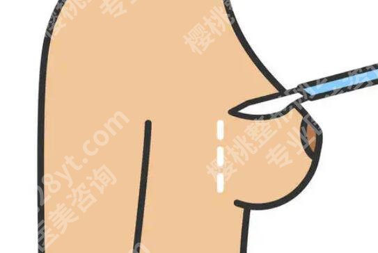九院谢峰脂肪填充案例展示！真实效果术后评价！
