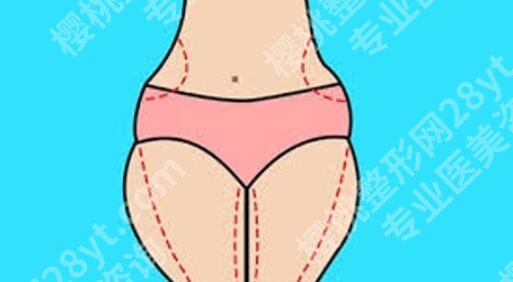 南宁瑞康医院美容整形怎么样？真人大腿吸脂案例分享！