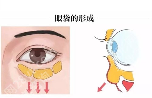 湛江附属医院美容科咋样？去眼袋案例前后对比图