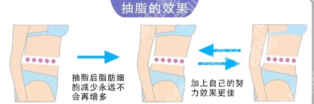 新桥医院整形科吸脂多少钱？院内哪位医生的技术比较好？真实口碑分享