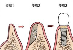 东直门口腔詹群英医生怎么样？医院简介，牙齿种植案例分享