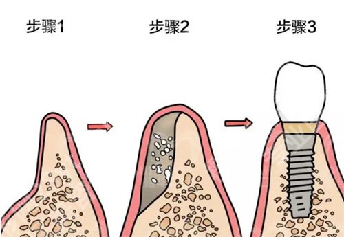 东直门口腔詹群英医生怎么样？医院简介，牙齿种植案例分享