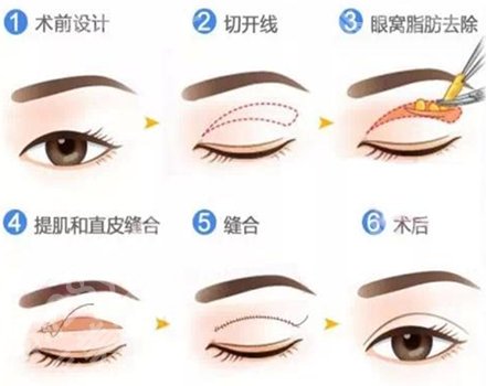 北京美莱做眼睛好的是哪个医生？余辉和李燕值得推荐