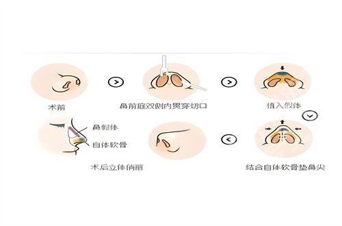 北京润美玉之光吸脂价格怎么样？展开医院优势的阐述