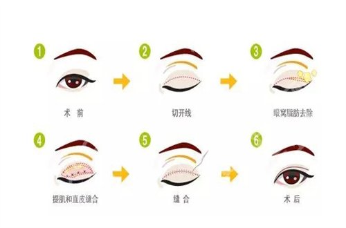 谢娟医生做双眼皮怎么样？医生个人简介+新价格表