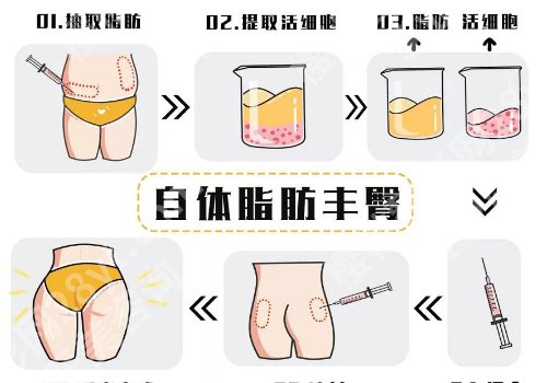 上海伊莱美整形医院脂肪填充价格需要多少?内附主打项目及医院简介