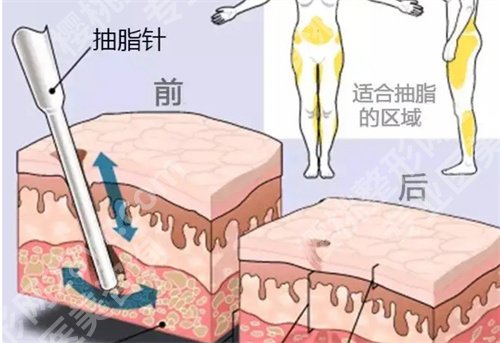 宁大附属医院吸脂多少钱？2024年价格表公布，项目推荐