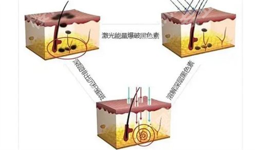 上海第一人民医院激光去痣大约多少钱？看详细价格表明细