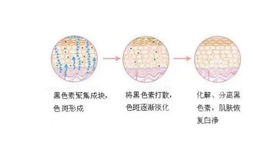 成都第二人民医院祛斑怎么样？看医院价格收费清单