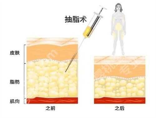 运城市中心医院整形科吸脂怎么样？看医院口碑、亮点介绍