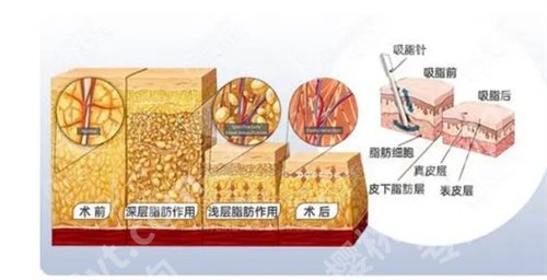 运城市中心医院整形科吸脂怎么样？看医院口碑、亮点介绍