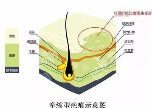 医学科学院整形外科医院激光去疤多少钱？看2024年收费