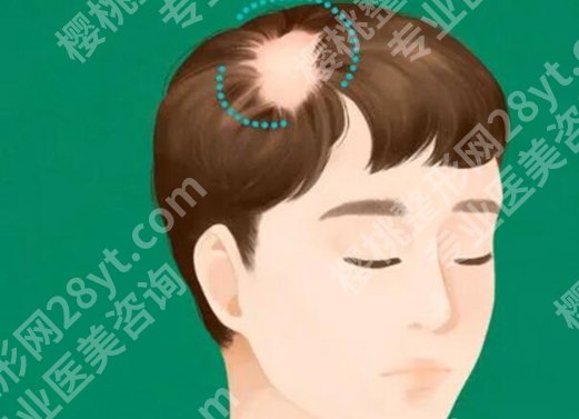 李宇飞植发成功率高吗？含医生资料和详细案例反馈