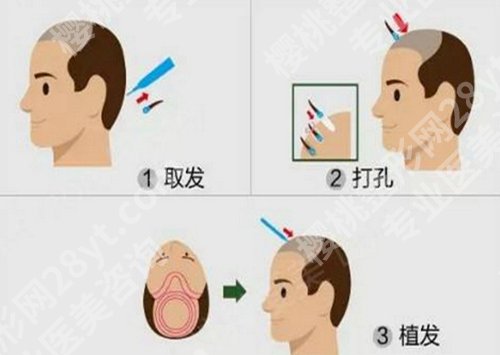 医学科学院整形外科医院植发价格是多少？植发价格为8000元起