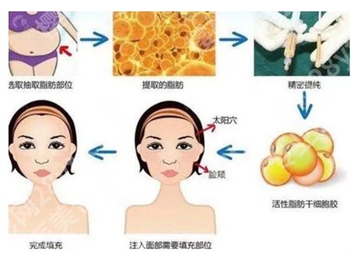杭州第一人民医院脂肪填充价格是多少？收费明细在线预览