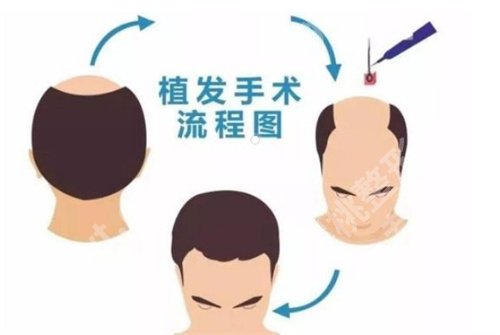 北京大学深圳医院植发中心怎么样？看医院的主打项目