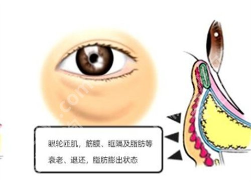 武汉项利姣做祛眼袋手术怎么样？医生实力测评，好评不断