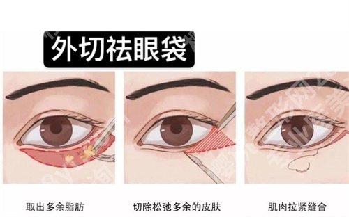 武汉项利姣做祛眼袋手术怎么样？医生实力测评，好评不断