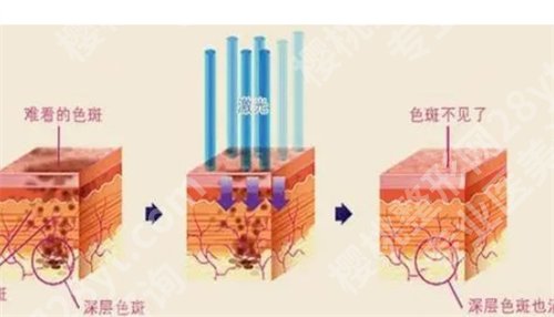 上海华美激光价格比九院贵真的吗？主打项目公布，细节曝光