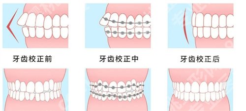 成都青苗口腔矫正花费是多少？价目收费明细