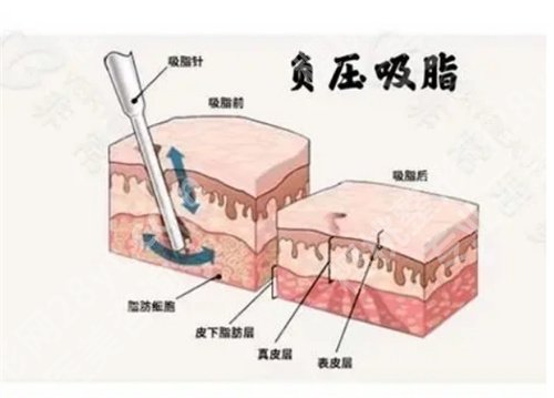 深圳艺星整形医院吸脂价格是多少？一览医院收费价格