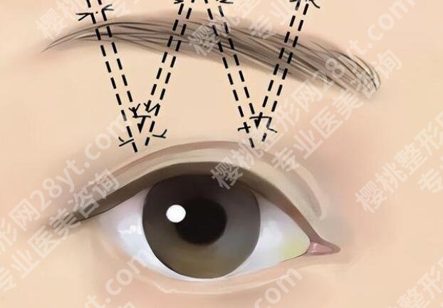 切眉整形一般多少钱？影响费用变动的因素有哪些？戳进来看
