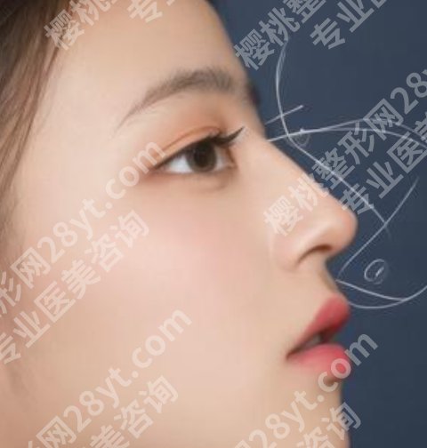 别筝医生的手术风格如何？鼻部整形项目科普！