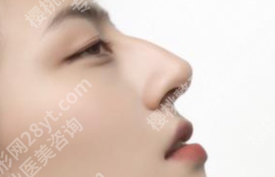 别筝医生的手术风格如何？鼻部整形项目科普！