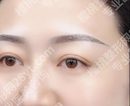 切眉整形是否是小手术？术后效果可以维持多久？注意事项盘点！