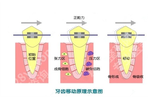 中山一院牙齿矫正怎么样？真人案例反馈中，点评告知