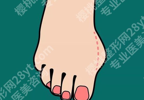 马桂文个人简历公布！医生技术点评、大脚骨真人案例、收费价格