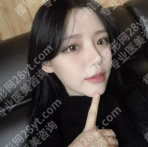 朴相根做双眼皮的案例怎么样？附双眼皮案例过程详情