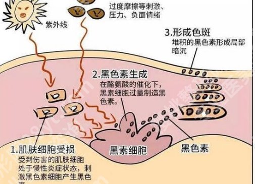 深圳大学总医院激光祛痣多少钱？医院简介，项目推荐