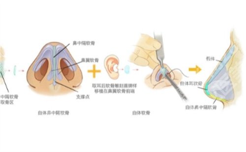上海王艳医生做鼻子怎么样？医生简介，好评不断