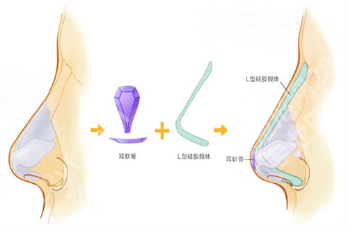 巫文云做鼻子怎么样?带你了解面诊详情技巧