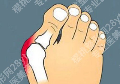 苏敬达做拇外翻什么价格？拇外翻手术价格为5987元起
