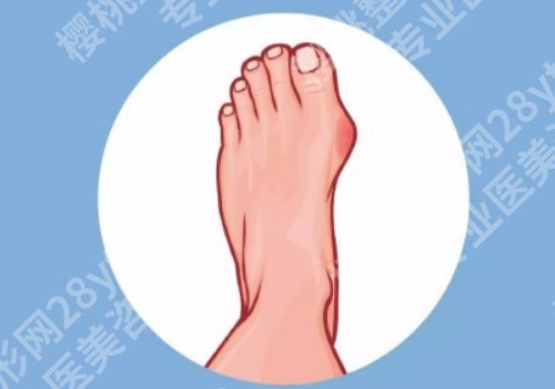 苏敬达做拇外翻什么价格？拇外翻手术价格为5987元起
