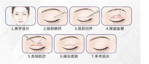 上海葛敏医生双眼皮技术怎么样？体验感真实反馈