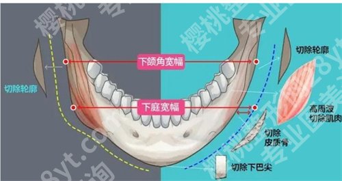 朴兴植做手术怎么样？看真实顾客点评