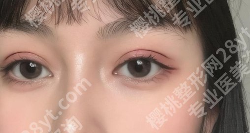 卢美均的星眸眼做的好不好？戳进来看真实的案例吧！