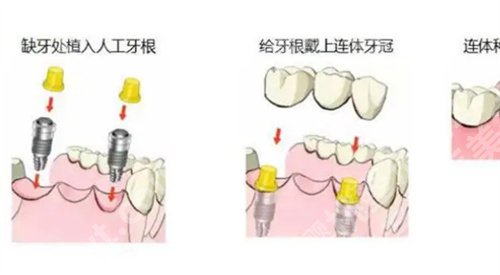 普宁人民医院种牙怎么样？医院详情介绍