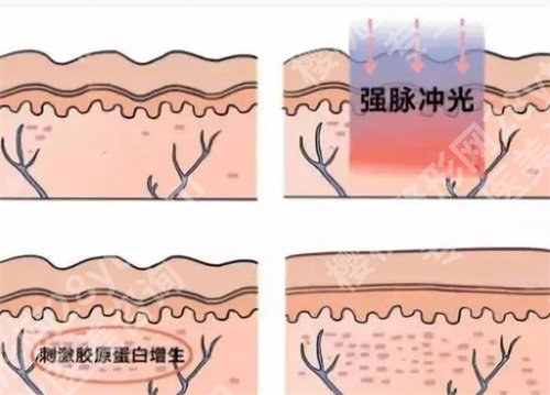 兰大二院光子嫩肤价格？价格表明细汇总