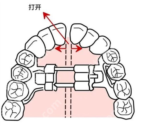 兰大二院正畸费用是多少？核心项目介绍