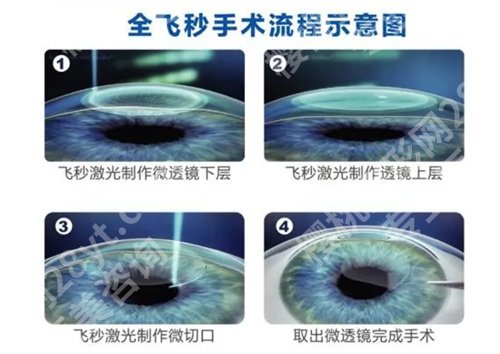 南方医院近视眼手术多少钱？全新价格在线了解