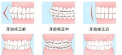 广州人民医院牙齿矫正需要多少钱？案例反馈