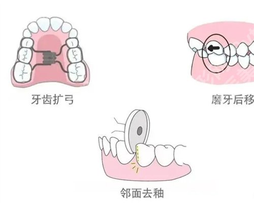广州人民医院牙齿矫正需要多少钱？案例反馈