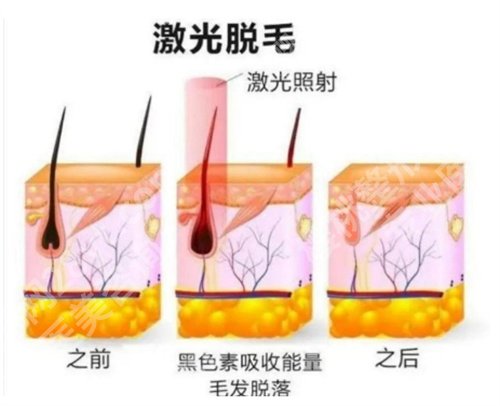 龙华人民医院整形科冰点脱毛收费如何？口碑点评来袭