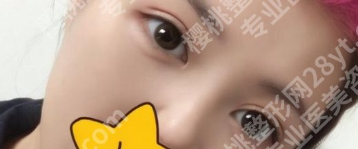宁波市杭州湾医院整形美容科眼部案例鉴赏！术后tips分享！